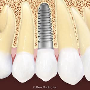 Here’s What You Can Expect With Dental Implant Surgery