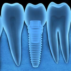 Could Your Metal Allergy Keep You From Obtaining Dental Implants?